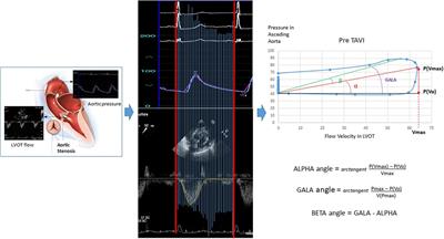 First description and validation of a new method for estimating aortic stenosis burden and predicting the functional response to TAVI